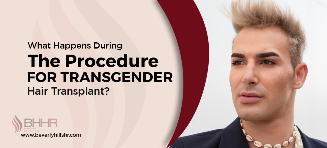 Transgender hair transplant 