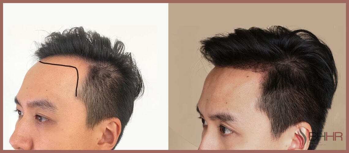 Hair Transplant PD