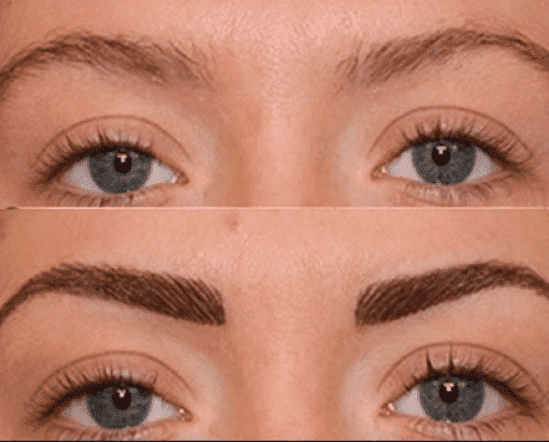 What is Eyebrow Transplant?   