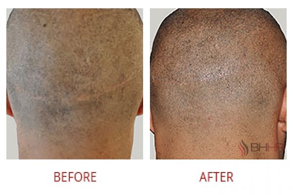 scalp-micropigmentation