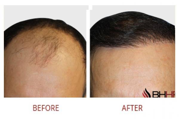 Hair Transplant Solutions