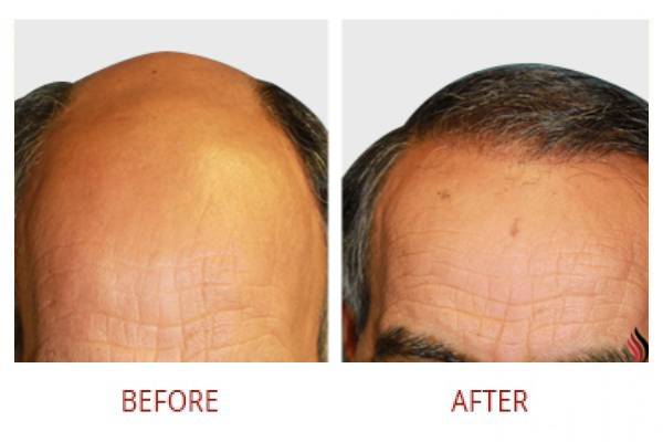 Hair Transplant Solutions